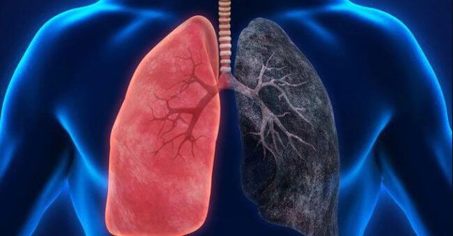 bệnh phổi tắc nghẽn mãn tính