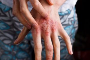 Viêm da cơ địa Vì sao chất lượng không khí trong nhà là yếu tố không thể bỏ qua_1