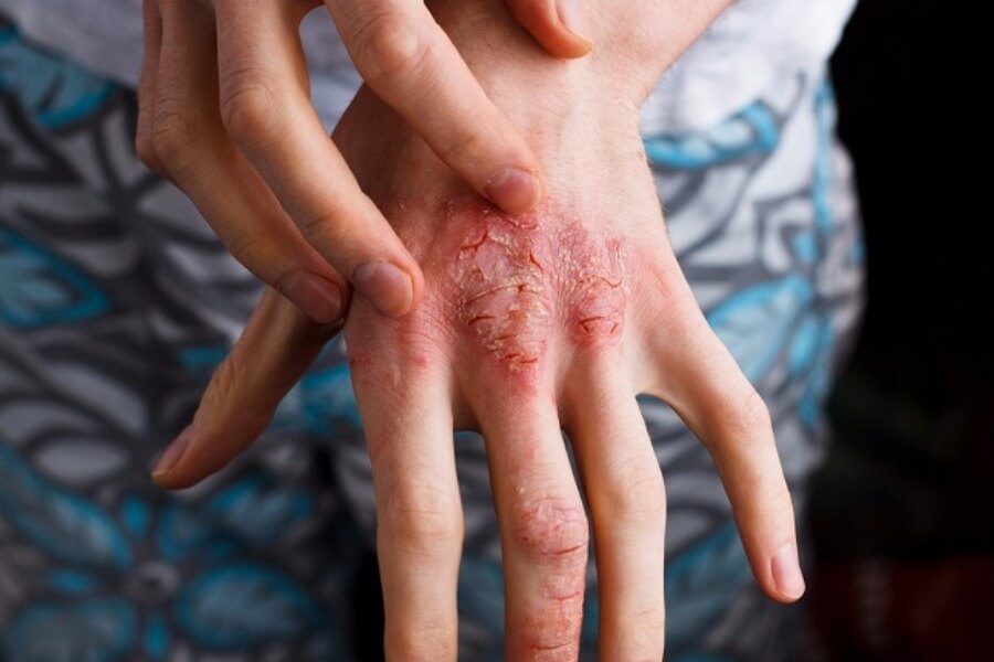 Viêm da cơ địa Vì sao chất lượng không khí trong nhà là yếu tố không thể bỏ qua_1